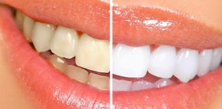 Видалення зубного нальоту в домашніх умовах — білосніжний ефект