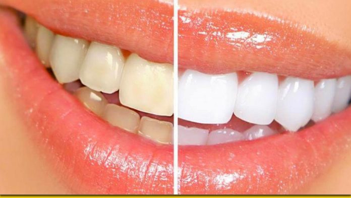 Видалення зубного нальоту в домашніх умовах — білосніжний ефект