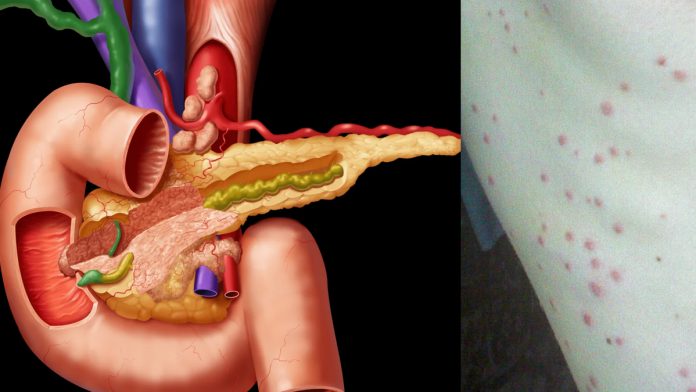 Червоні точки на тілі - все про симптоми панкреатиту