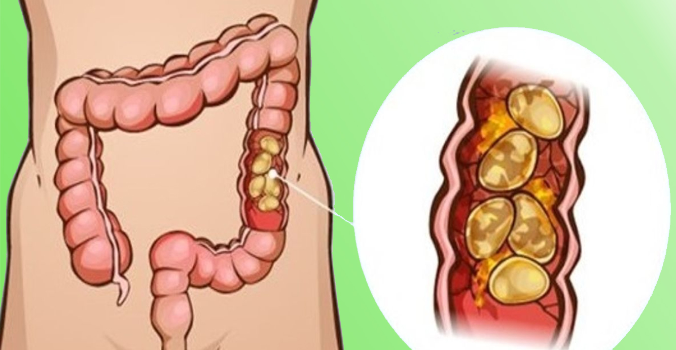 Каловые камни в кишечнике