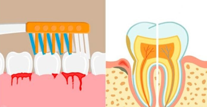 кровоточать ясна