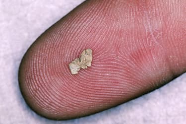 princ_rm_photo_of_kidney_stone_on_fingertip.jpg?resize=375px:250px&output-quality=50