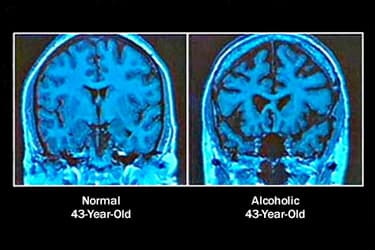 493ss_science_source_rm_normal_vs_alcoholic_brain.jpg?resize=375px:250px&output-quality=50