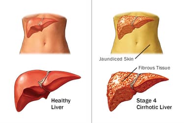493ss_medical_images_rm_healthy_vs_cirrhotic_liver.jpg?resize=375px:250px&output-quality=50