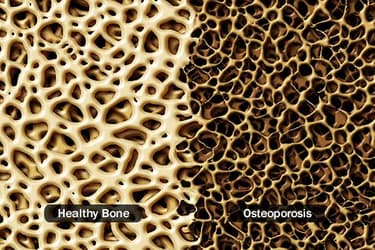 493ss_thinkstock_rf_healthy_bone_vs_osteoporosis.jpg?resize=375px:250px&output-quality=50