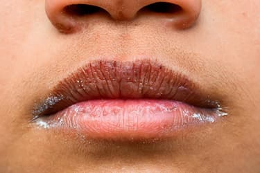 493ss_getty_rf_dry_lips.jpg?resize=375px:250px&output-quality=50