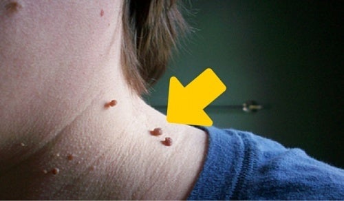 6 Tips to Naturally Remove Skin Tags