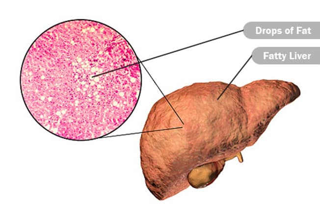 Harm: Liver Disease