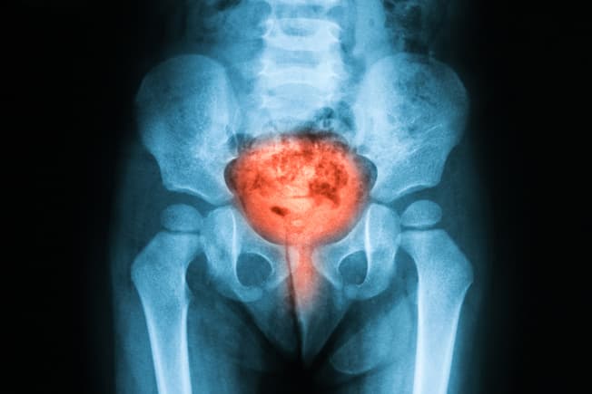 Painful Bladder Syndrome