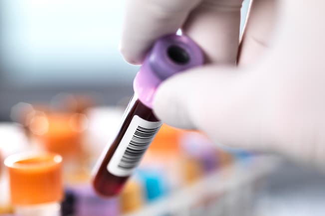 A Blood Test Diagnoses It